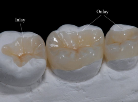 İnley / Onley Porselen