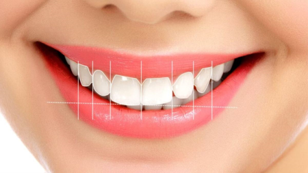 Gülüş Tasarımı (Hollywood Smile) Nedir?