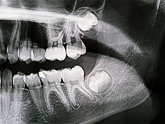 20 Yaş Diş Çekimi Sonrası Sigara