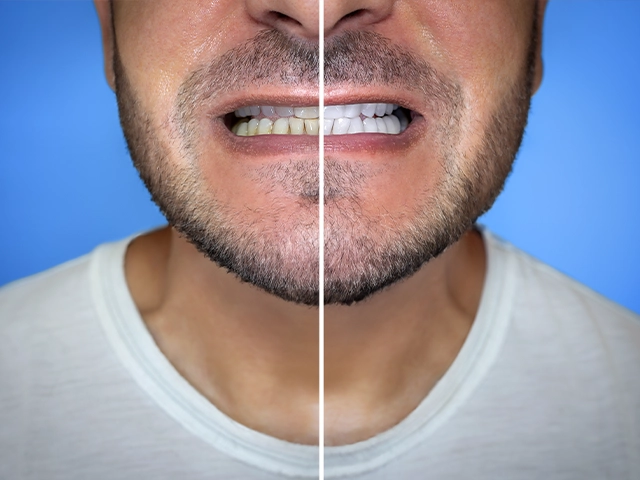 Hollywood Gülüşü Öncesi Sonrası