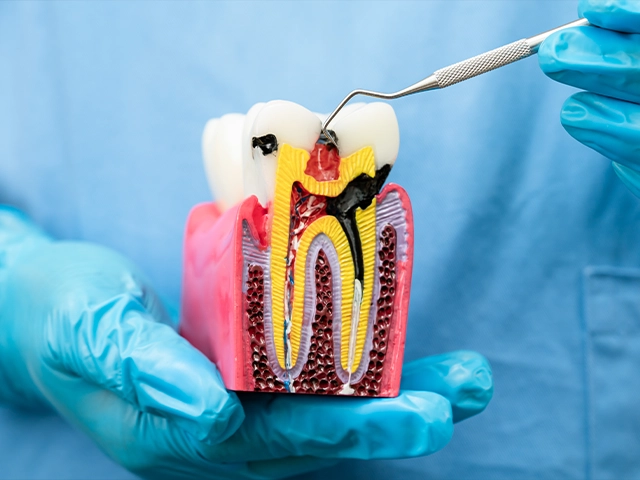 Kanal Tedavisi ve Dolgu Aynı Gün Yapılır Mı?