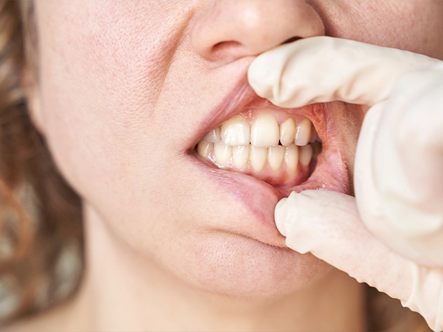 Kekik Diş Eti Çekilmesine İyi Gelir Mi